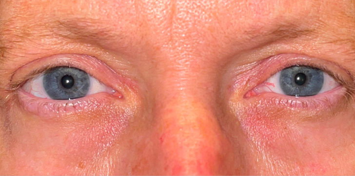 Upper Eyelid Blepharoplasty After