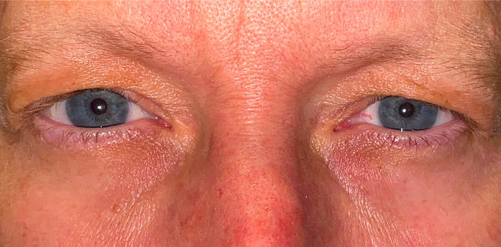 Upper Eyelid Blepharoplasty Before