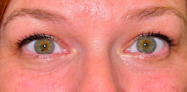 Four Lid Blepharoplasty with Periocular CO2 Laser Resurfacing After