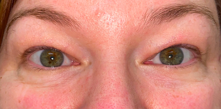 Four Lid Blepharoplasty with Periocular CO2 Laser Resurfacing Before