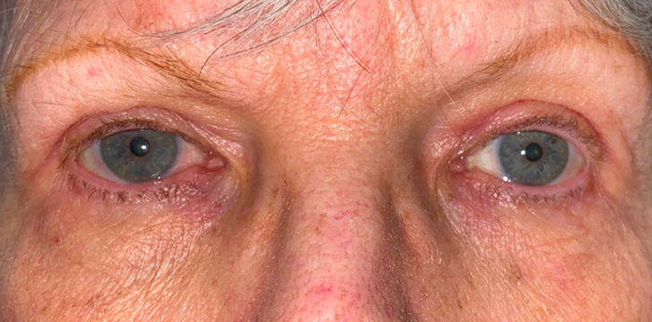 Upper Eyelid Blepharoplasty After