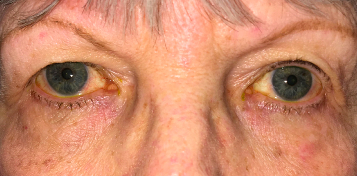 Upper Eyelid Blepharoplasty Before