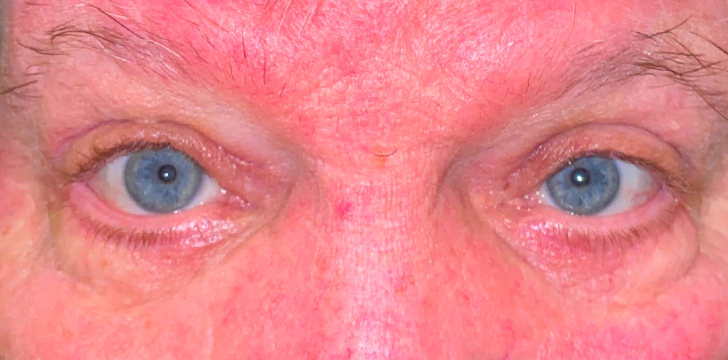 Four Lid Blepharoplasty with Periocular CO2 Laser Resurfacing After