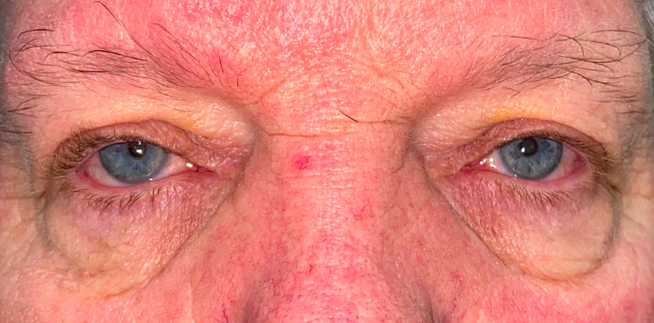 Four Lid Blepharoplasty with Periocular CO2 Laser Resurfacing Before