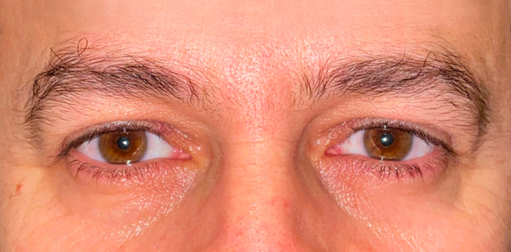 Upper Blepharopalsty and Browpexy After