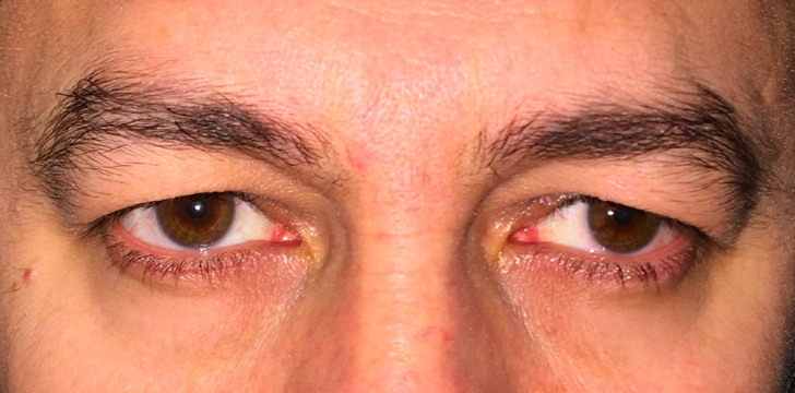 Upper Blepharopalsty and Browpexy Before
