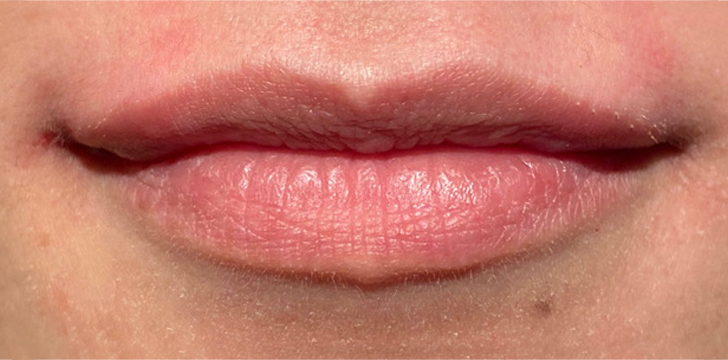 Lip Filler After