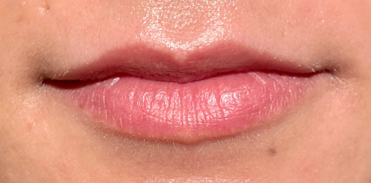 Lip Filler Before