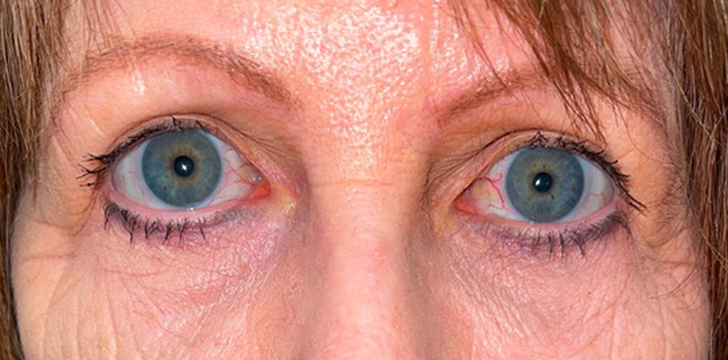Upper Blepharoplasty and Brow Lift After