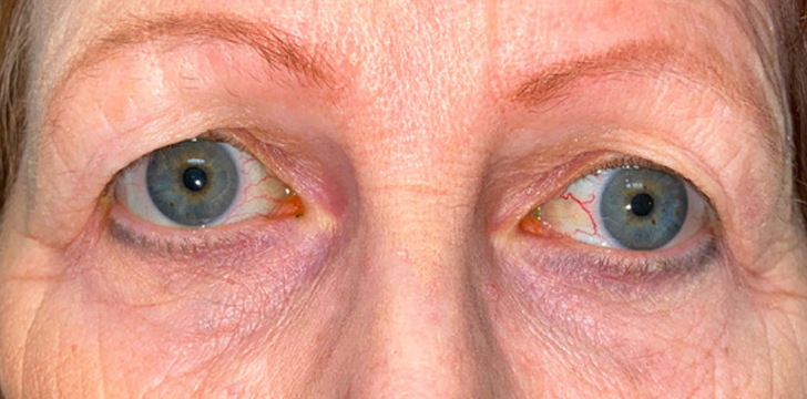 Upper Blepharoplasty and Brow Lift Before
