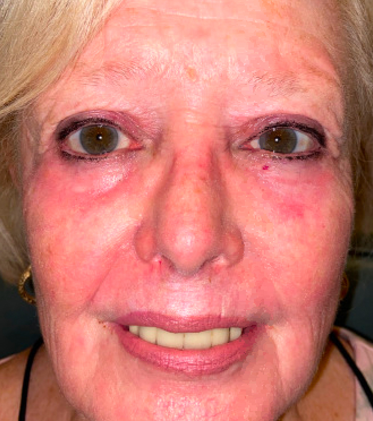 Four Lid Blepharoplasty with Full Face CO2 Laser Resurfacing After