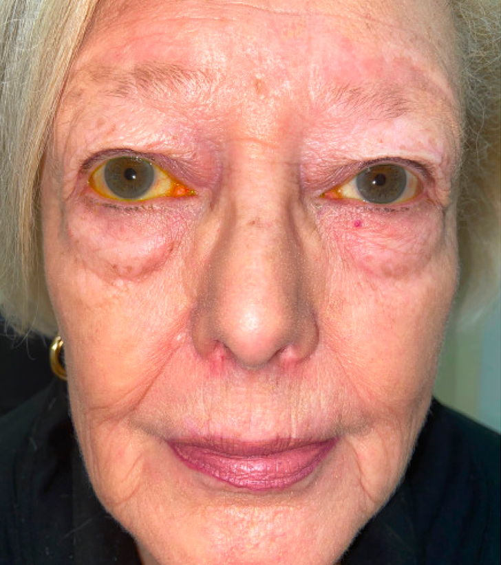 Four Lid Blepharoplasty with Full Face CO2 Laser Resurfacing Before