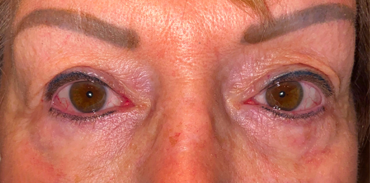 Ptosis Repair After
