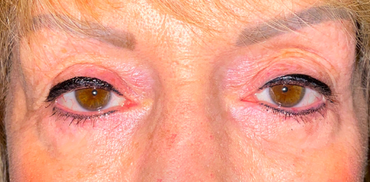Ptosis Repair Before