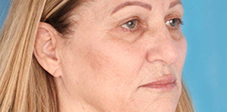 Lower Blepharoplasty and Face Lift Before