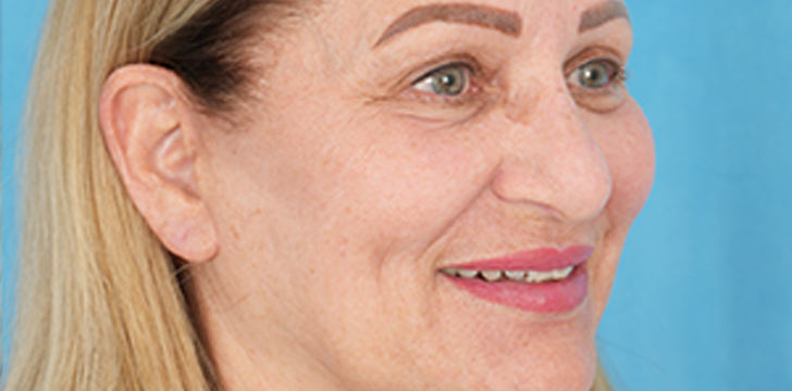 Lower Blepharoplasty and Face Lift After