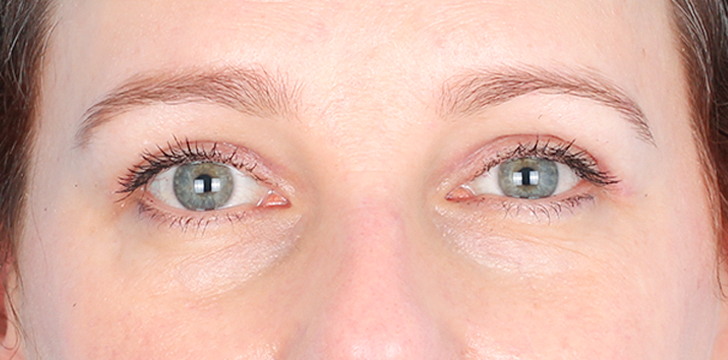 Upper Blepharoplasty After
