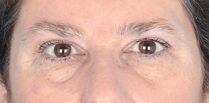 Brow Lift and upper Blepharoplasty After