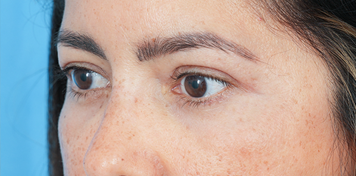 Four Lid blepharoplasty After