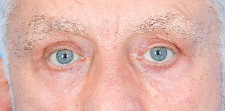 FatRepo Blepharoplasty After