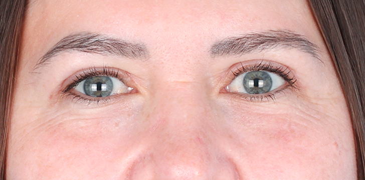 Upper Blepharoplasty and Browpexy After