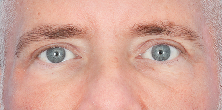 Upper Blepharoplasty and Browpexy After