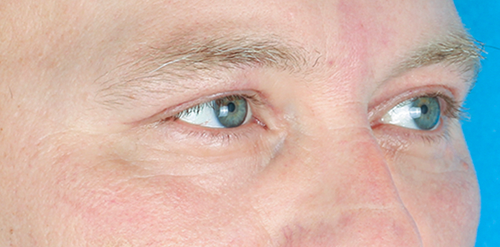 Blepharoplasty and Periocular Resurfacing After