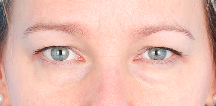 Upper Blepharoplasty Before