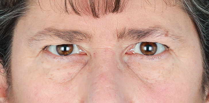 Brow Lift and upper Blepharoplasty Before