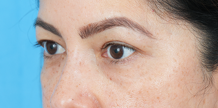 Four Lid blepharoplasty Before