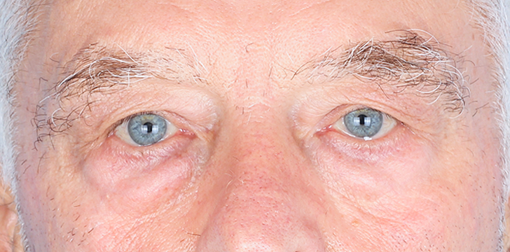 FatRepo Blepharoplasty Before