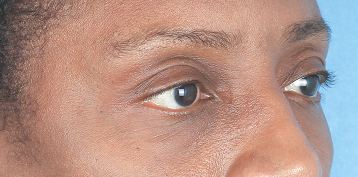 FatRepo Blepharoplasty Before