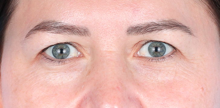Upper Blepharoplasty and Browpexy Before