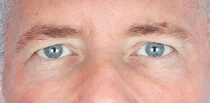 Upper Blepharoplasty and Browpexy Before