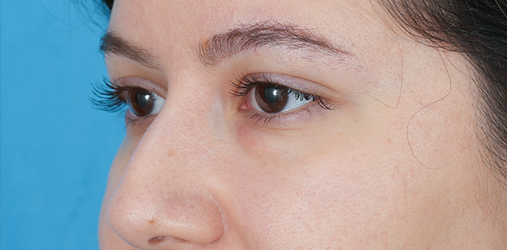 Four Lid blepharoplasty After