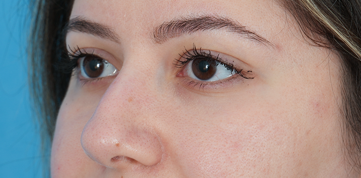 Four Lid blepharoplasty Before
